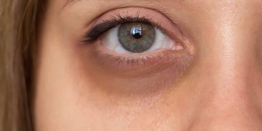 Eyelid Surgery in Riyadh