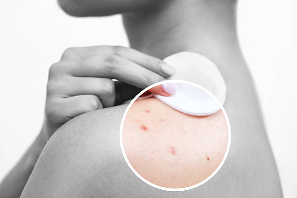 How to Treat Back Acne and Its Effects?