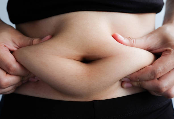 Tummy tuck surgery in Riyadh