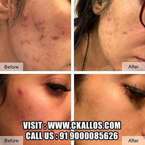 Clear Acne Fast β Proven Treatment for Pimples & Breakouts
