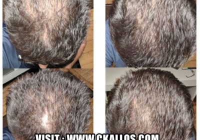Hair-transplant-1
