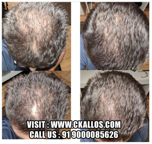 Best Hair Transplant Clinic Near You – Affordable & Effective