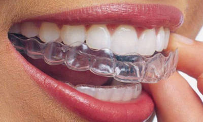 mouthguard-400×241-1