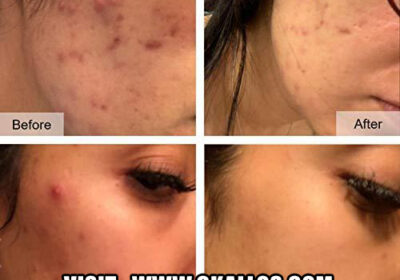 Clear-Acne-Fast-2