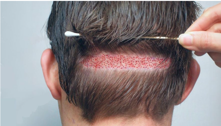 Hair Specialist in Lahore | Best Hair Transplant in Pakistan By Dr. Burhan Ashraf