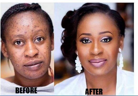 Permanent Skin Bleaching Oil In Smithville City in Missouri, Skin Whitening Products In Stony Stratford Town in England Call ☏ +27710732372 Scars And Stretch Marks Removal Cream In Rustenburg, Pimple Treatment In Louis Trichardt South Africa