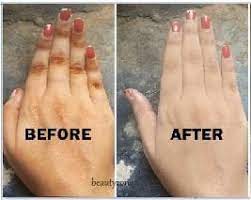 Get Rid Of Vitiligo In Chalfont Saint Giles Village in England And Vaasa City In Finland Call +27710732372 Scars And Stretch Marks In Lathrop City in Missouri And Vereeniging City In South Africa