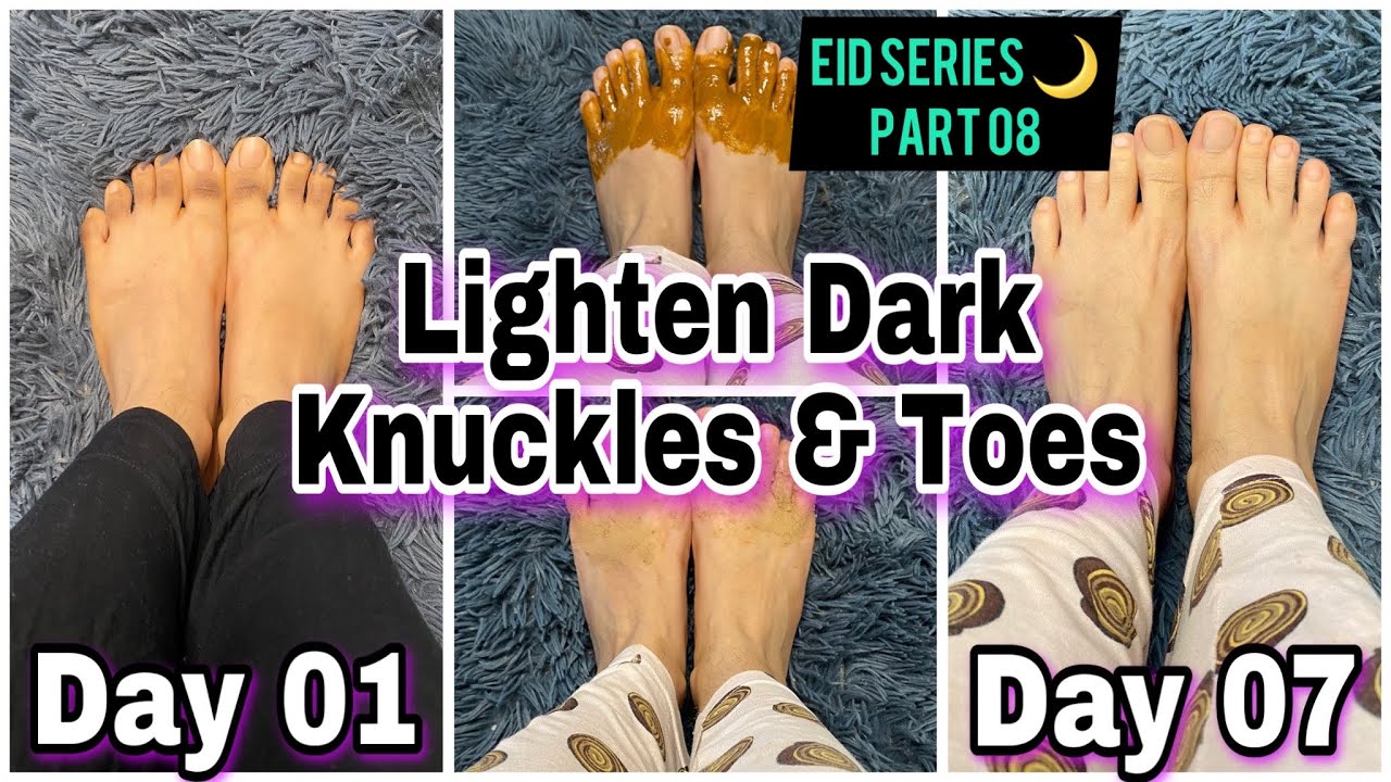 Permanent Skin Bleaching Oil In Smithville City in Missouri, Skin Whitening Products In Stony Stratford Town in England Call ☏ +27710732372 Scars And Stretch Marks Removal Cream In Rustenburg, Pimple Treatment In Louis Trichardt South Africa