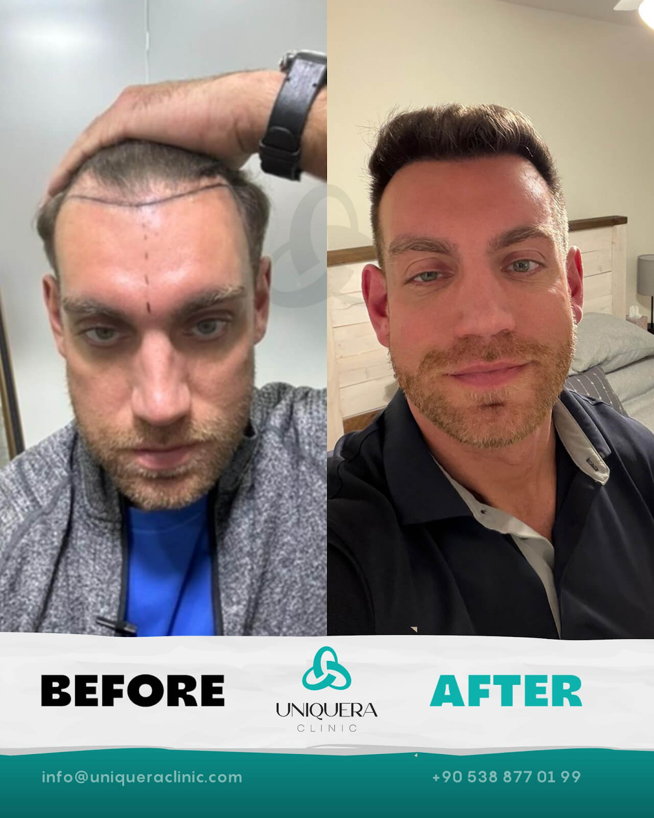 Trusted Hair Transplant Clinic in Istanbul