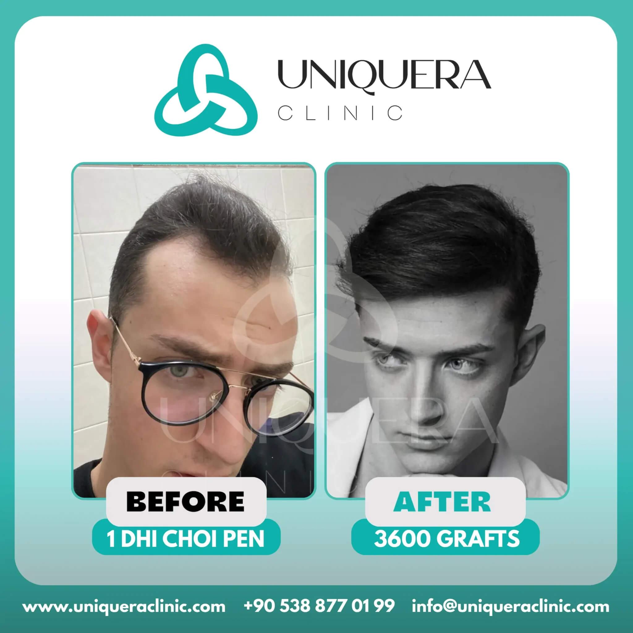 Premier Destinations for Afro Hair Transplant Treatment