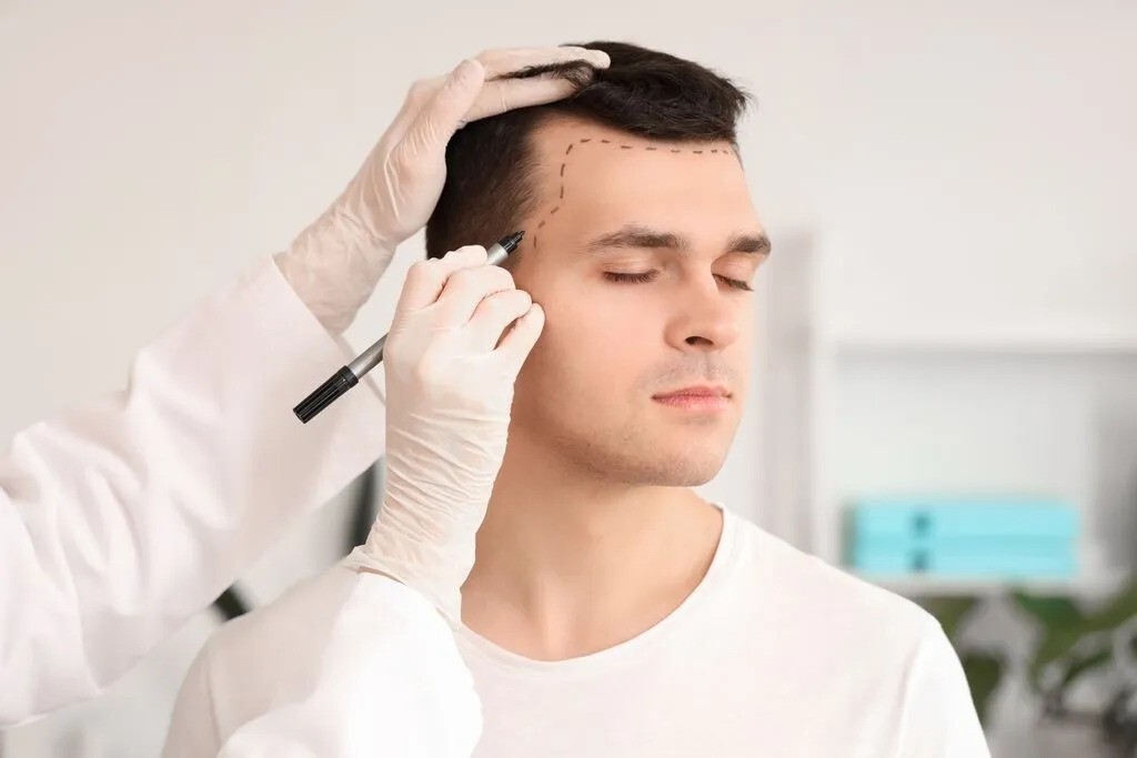 Hair transplant in Islamabad Pakistan