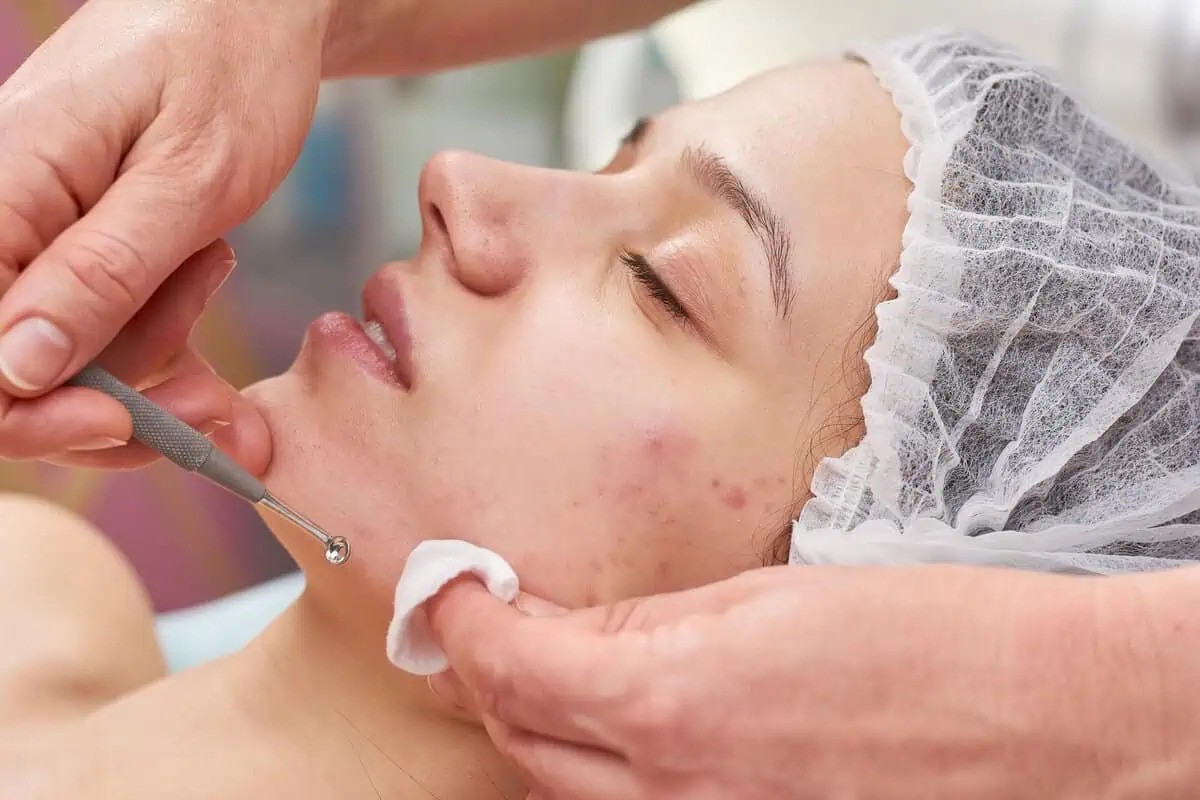 Best Acne scars in Islamabad