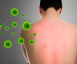 Allergic-Inflammation