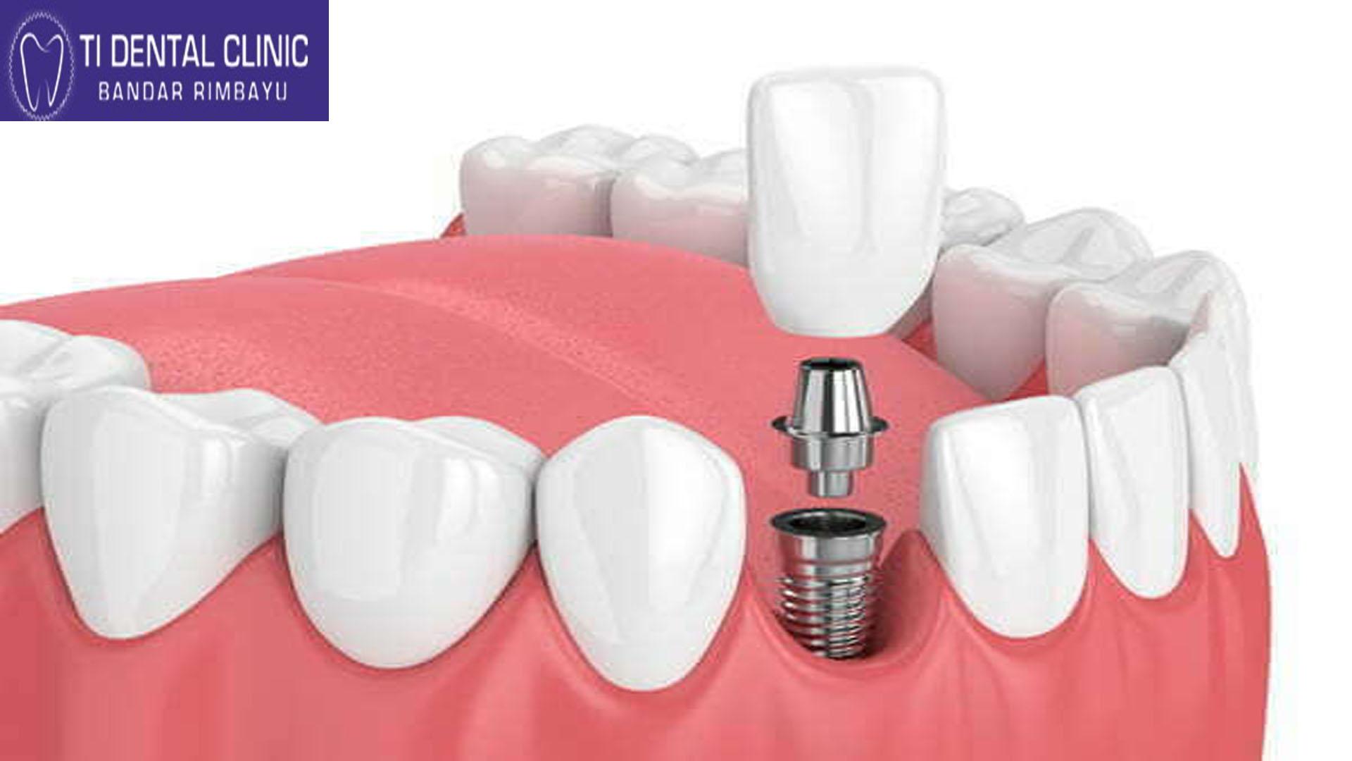 Material Science in Aesthetic Dentistry: Composite vs. Porcelain Veneers