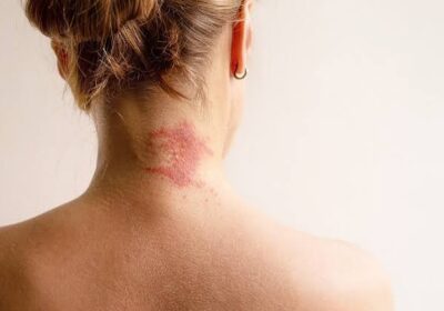 Allergy-News